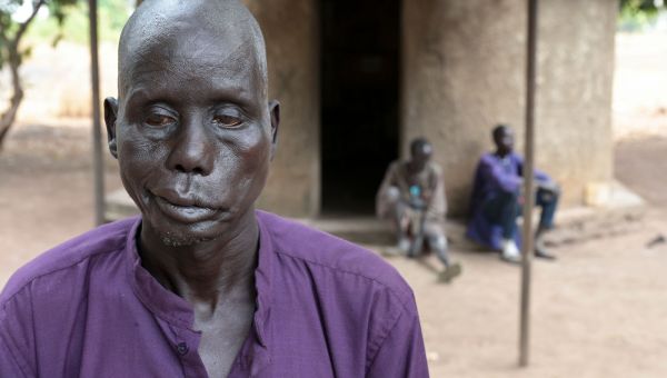 Ein Mann blickt im Vordergrund betrübt ins Leere, hinten sitzen zwei Männer sitzen vor einer Hütte im Lepradorf Agok. 